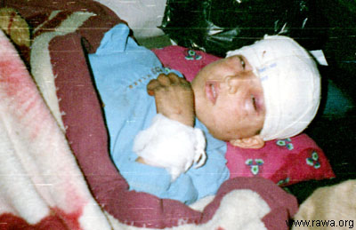 Wounded child in Jalalabad